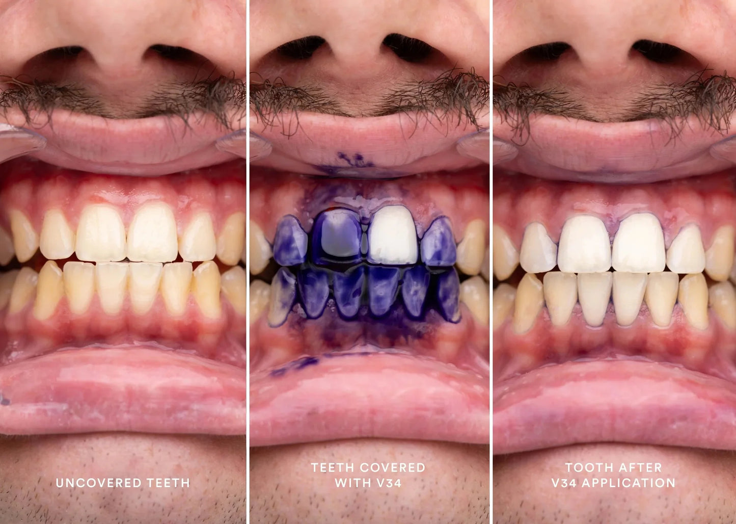 Best-selling v34 teeth whitening toothpaste (Buy 2 get 1 free & free home delivery )